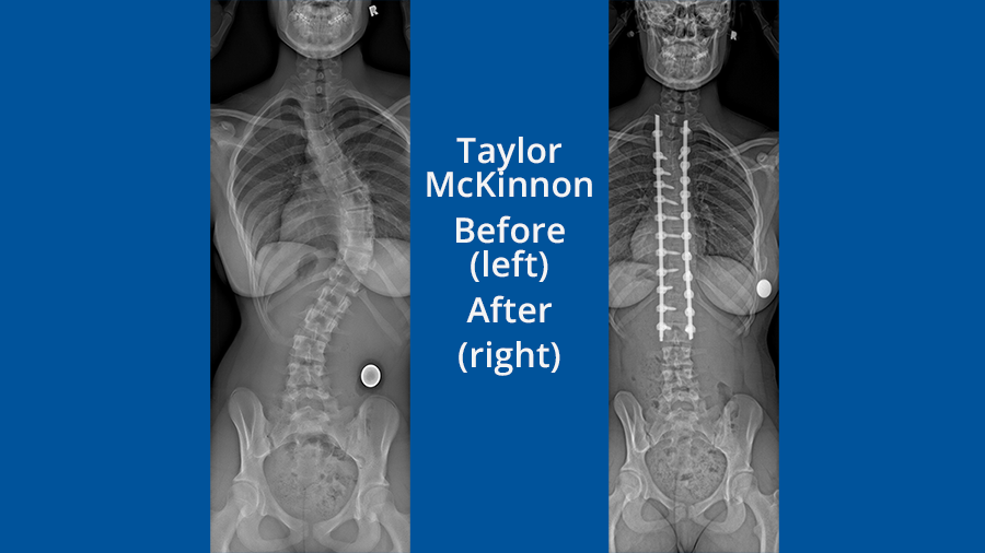 A before and after radiograph of Taylor McKinnon's spine