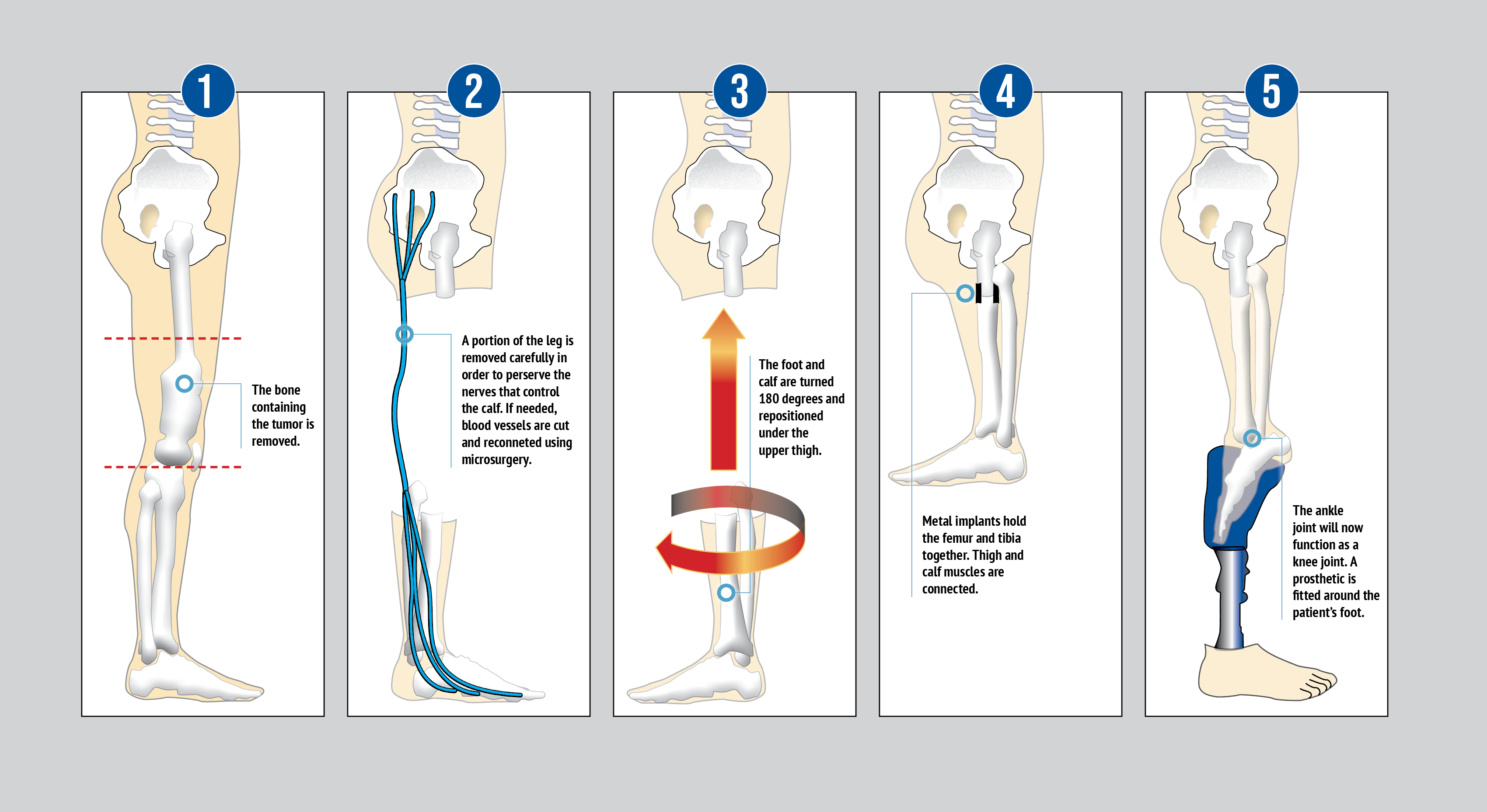 Rotationplasty